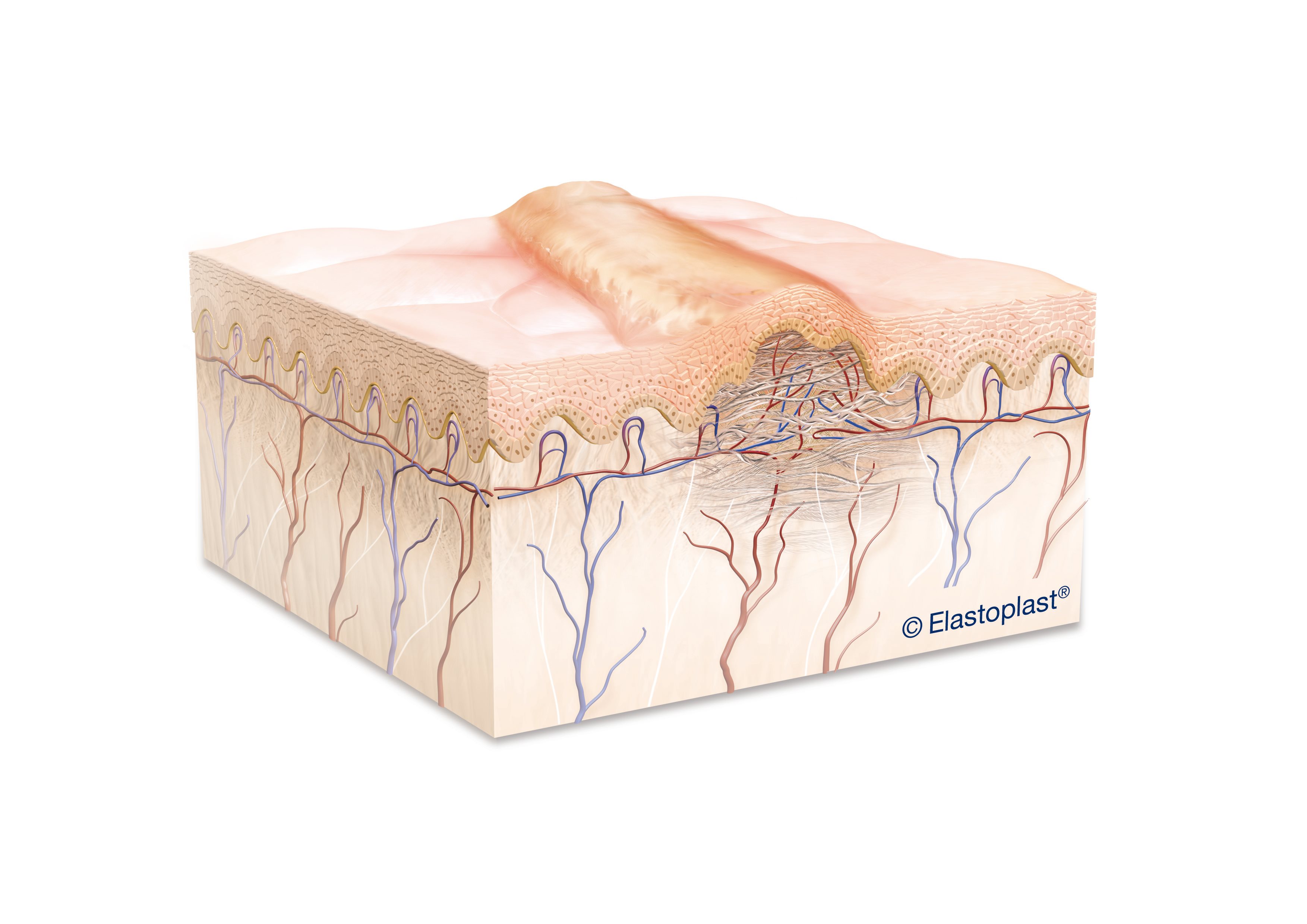 biological diagram of a hypertrophic scar