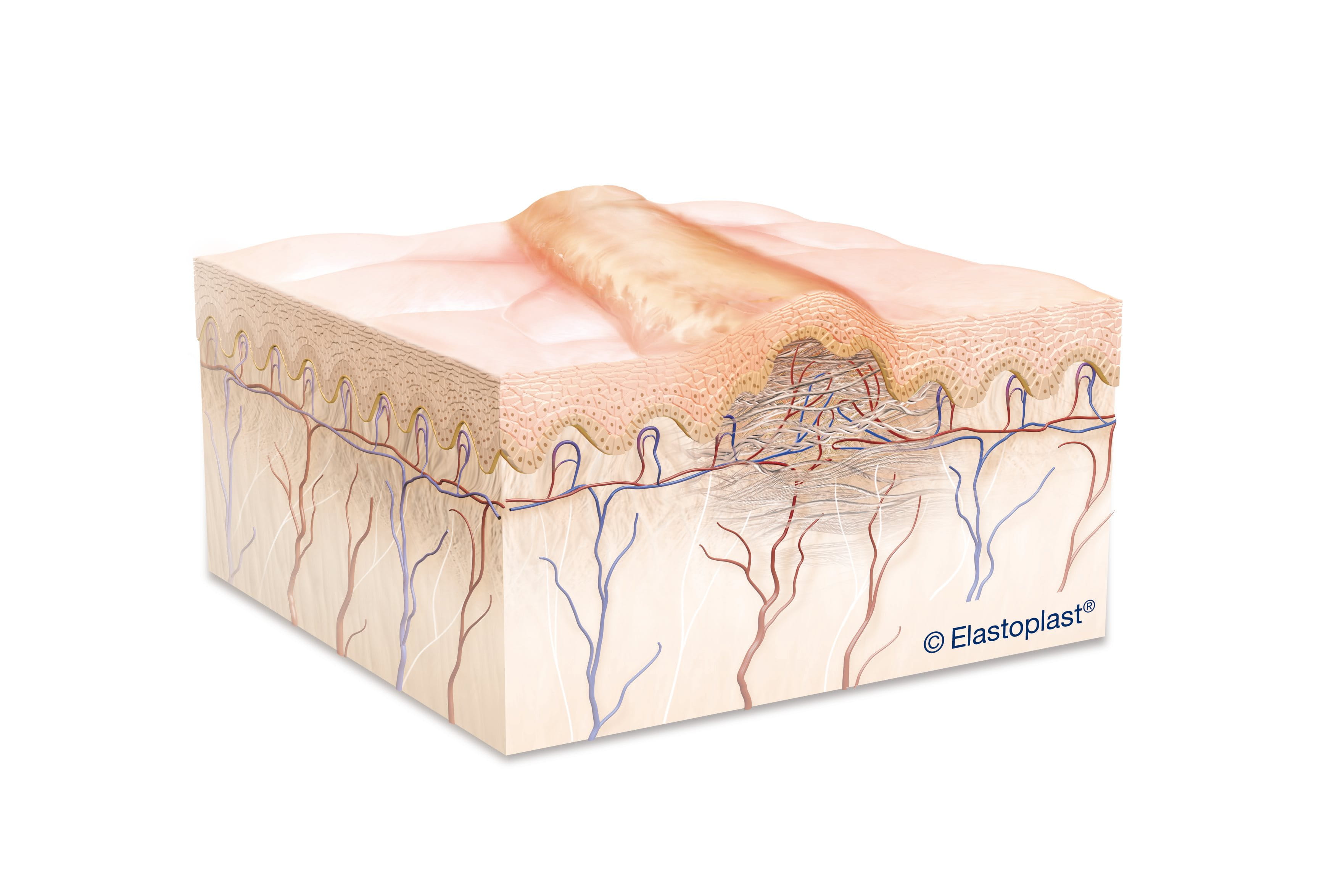 diagram of a hypertrophic scar