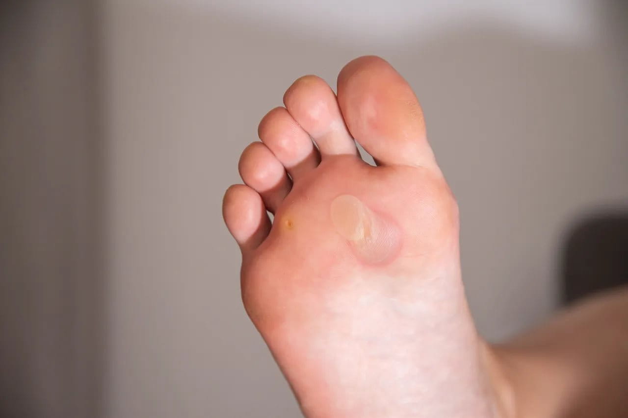 Kapalan yang terjadi di kaki