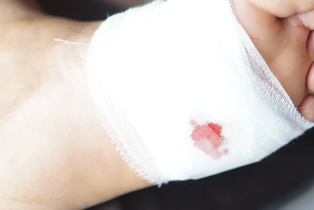 Luka tusuk pada kaki perlu penanganan khusus