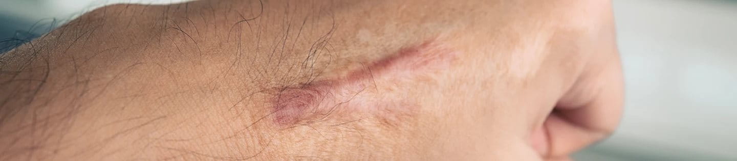 Close up image on a scar on a person's hand