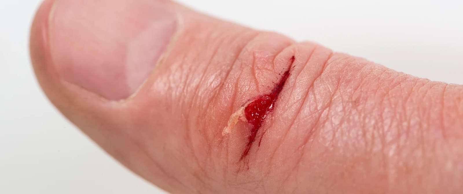 luka baret di tangan