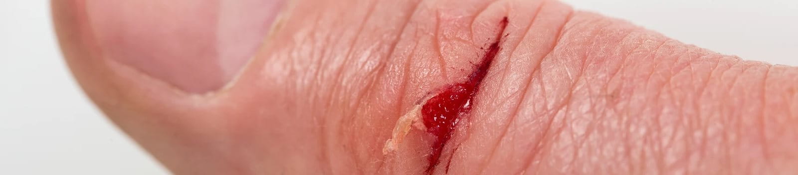 luka baret di tangan