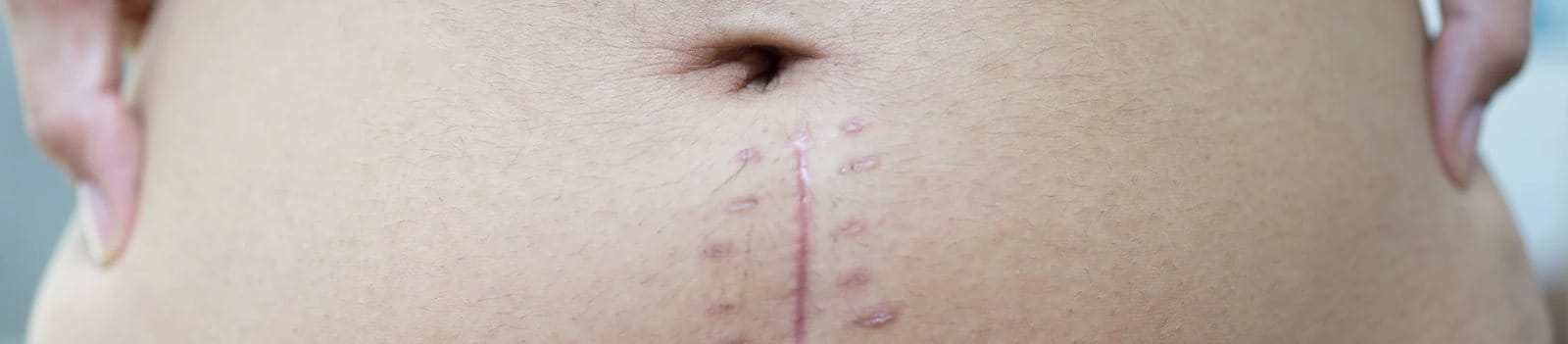 Jahitan bekas luka operasi