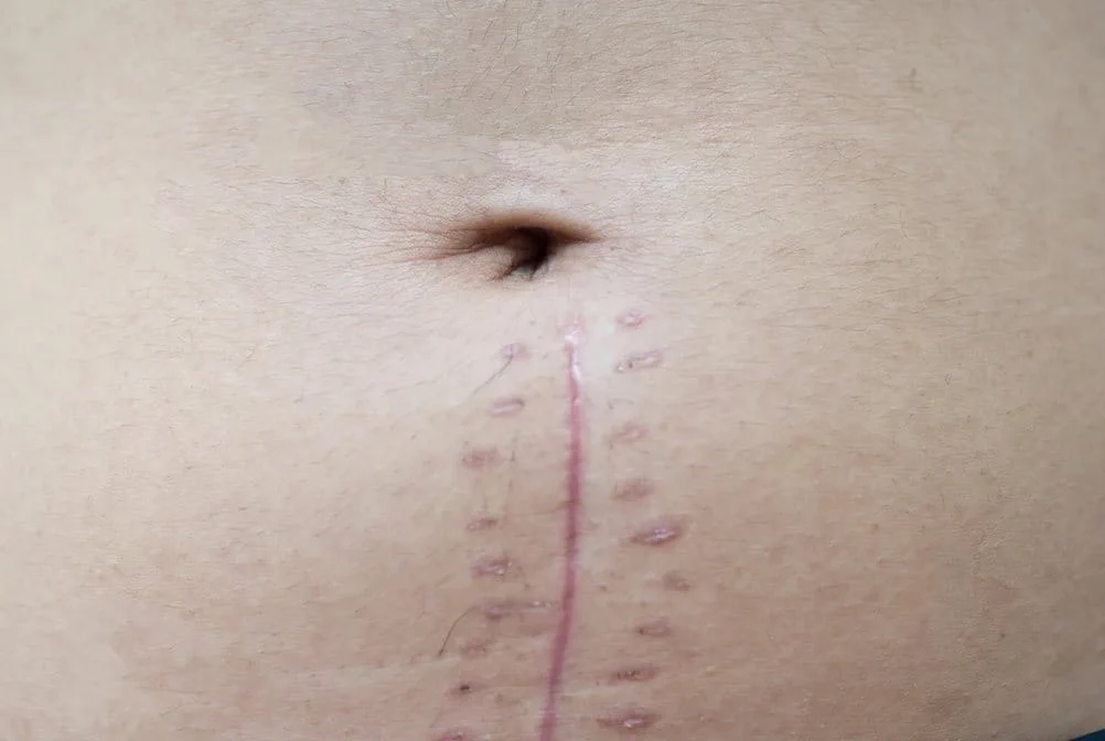 Jahitan bekas luka operasi