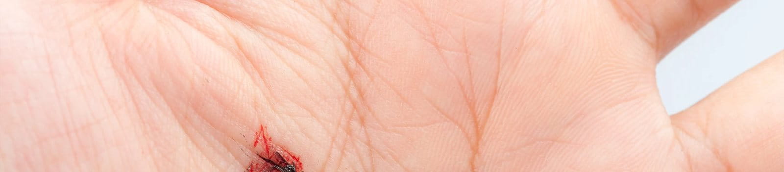 Tangan yang digigit serangga